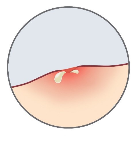 Surgical Incision Care Basics | BAND-AID® Brand Adhesive Bandages